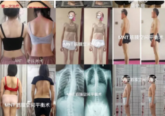 脊柱侧弯 体态处理 急性慢性痛症处理