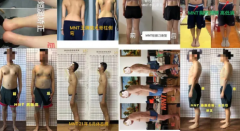 脊柱侧弯 体态处理 急性慢性痛症处理
